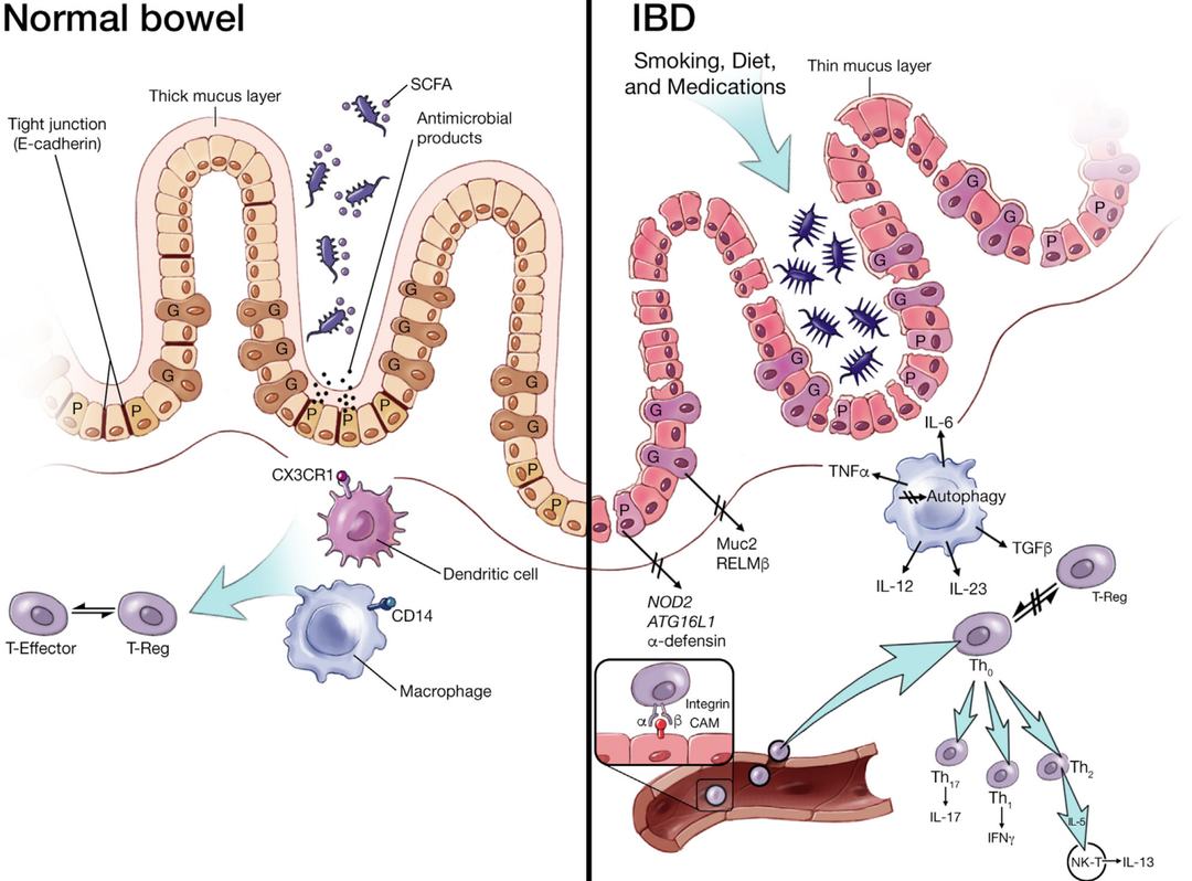 炎症性肠炎IBD模型